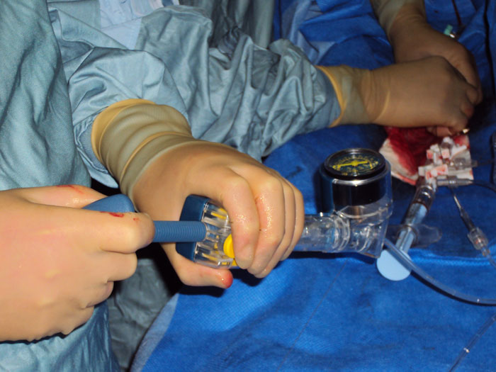 Encore inflator in use